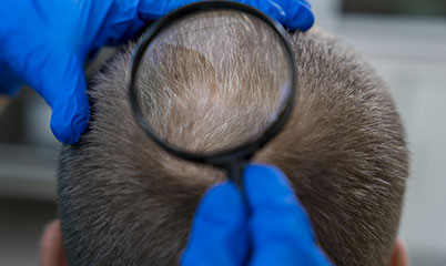 Alopecia areata